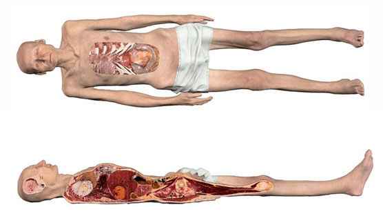 Virtual visualization of a real geriatric cadaver from a patient with lung cancer added to Anatomage Bodies, used for anatomy education and medical training.