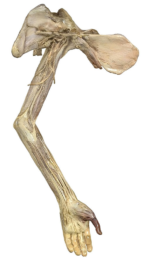 3D visualization of a human arm displayed using Anatomage’s technology, illustrating anatomical variation for use in human anatomy education and medical training.
