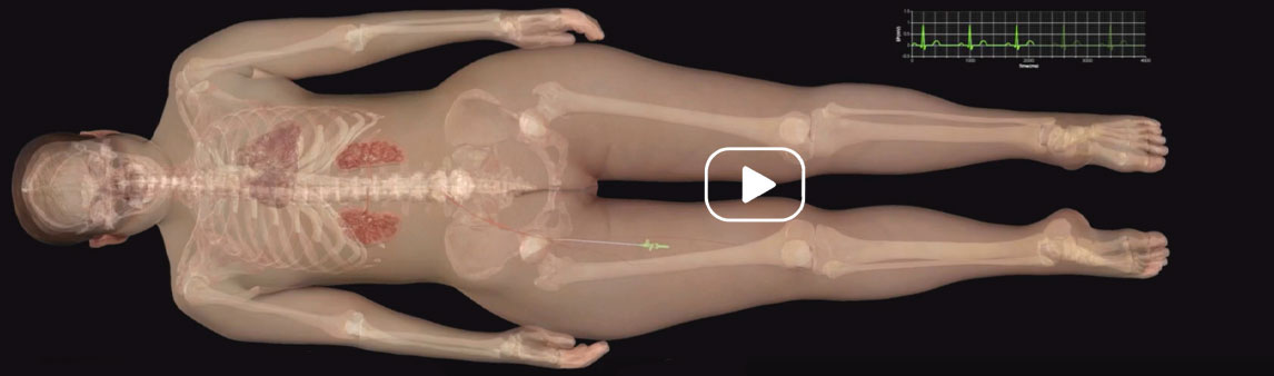 Coronary Angiogram simulation shown on Anatomage's 3D technology used for medical education and anatomy study.