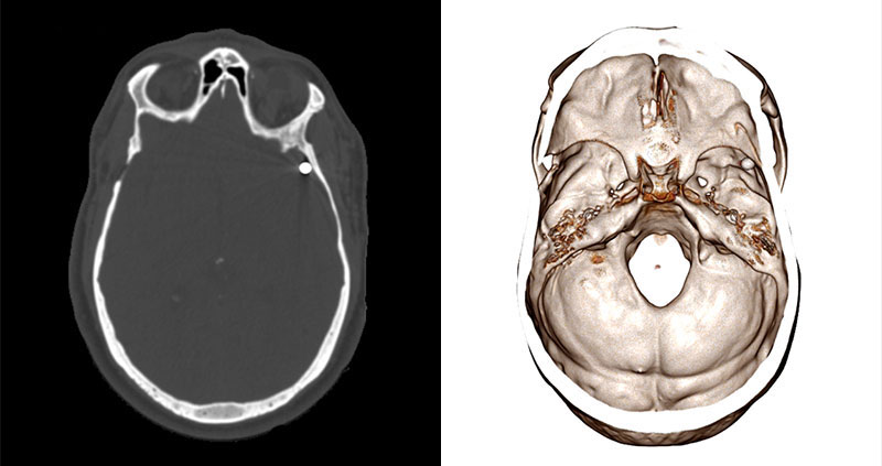 Side-by-side comparison of a CT scan of a gunshot wound and the volumetric rendering on the Anatomage Table.