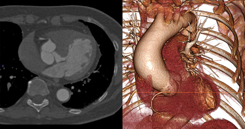 Side-by-side comparison of a CT scan of a stable thoracic aneurysm and its volumetric rendering.