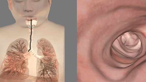 Virtual bronchoscope to discover pathologies.
