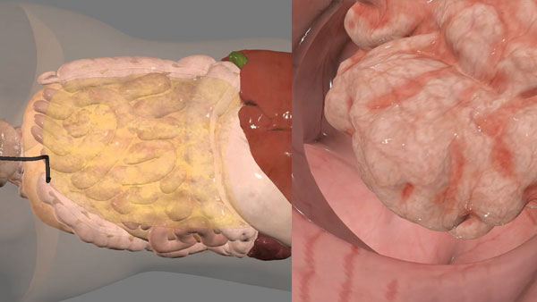 Visualize the colon’s interior with pathological anatomy in 3D.