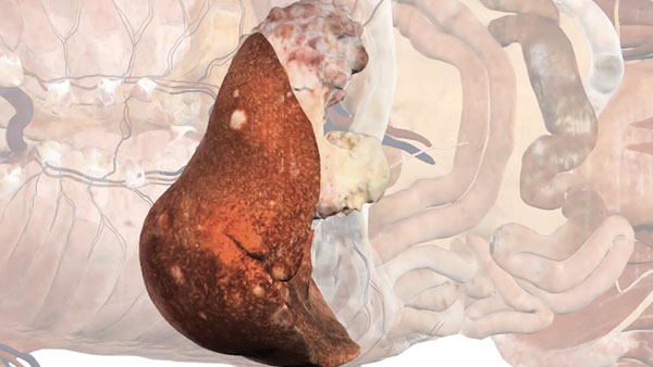Metastatic pancreatic cancer in a real human 3D digitized cadaver.