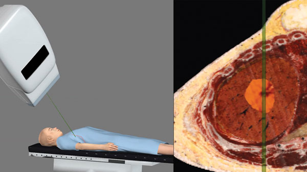 Stereotactic body radiotherapy procedure simulation for liver cancer treatment.