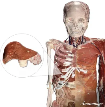 Real human digital cadaver with callout to liver and pancreas with metastases.
