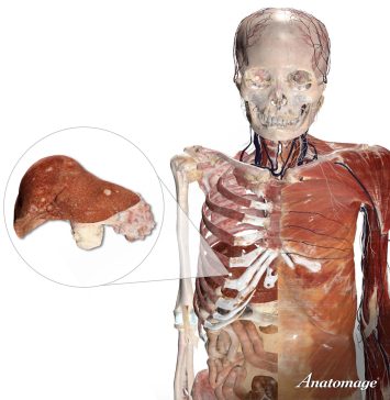 Real human digital cadaver with callout to liver and pancreas with metasteses.